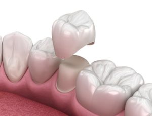 Can Rotten Teeth Be Saved crown