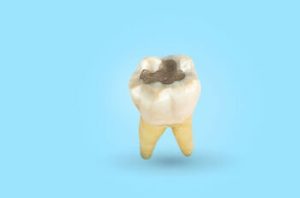 Can Rotten Teeth Be Saved decay