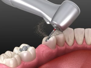 Can Rotten Teeth Be Saved treatment